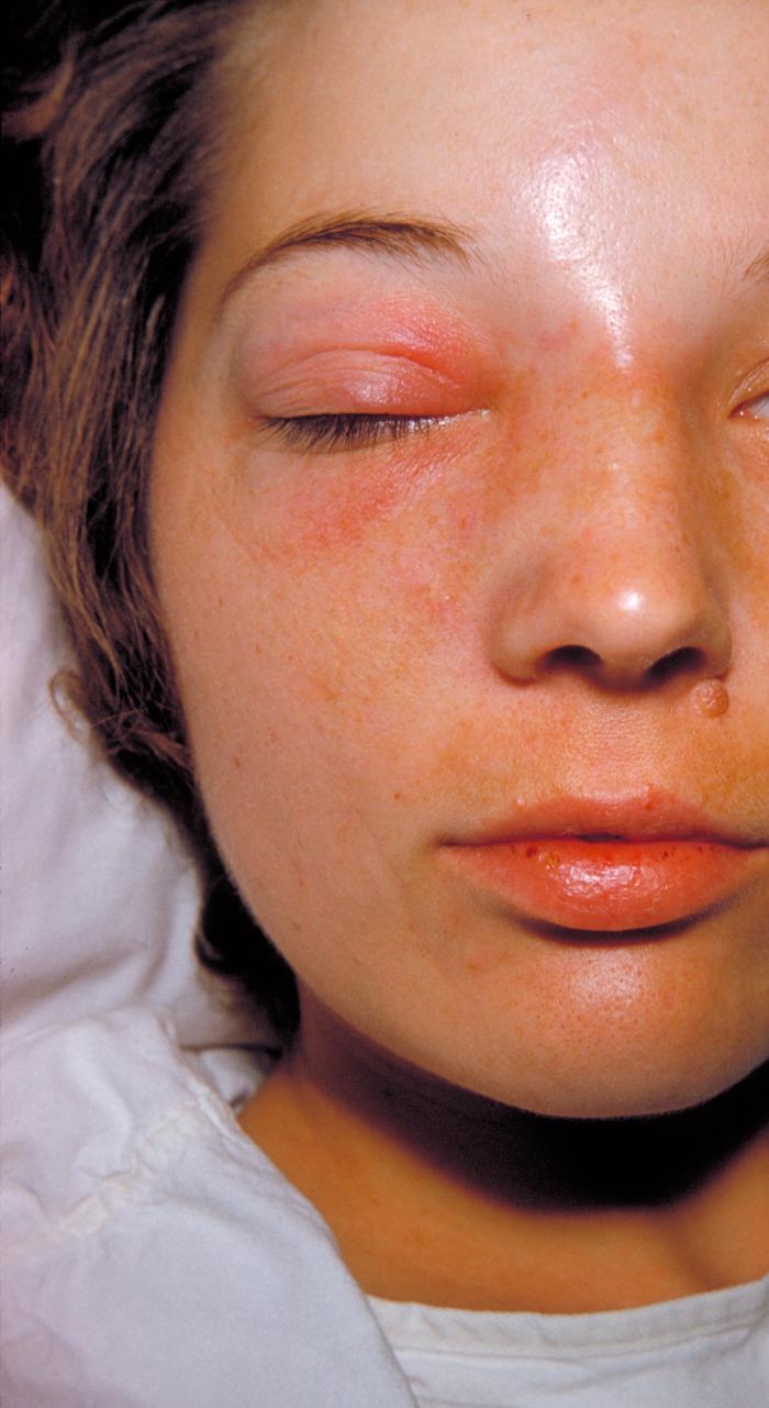 MRSA Methicillin Resistant Staphalococcus - Staph Infection - Cellulitis On Face