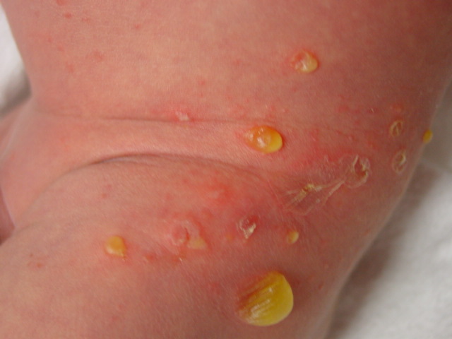 MRSA Methicillin Resistant Staphalococcus - Staph Infection - Impetigo On Baby