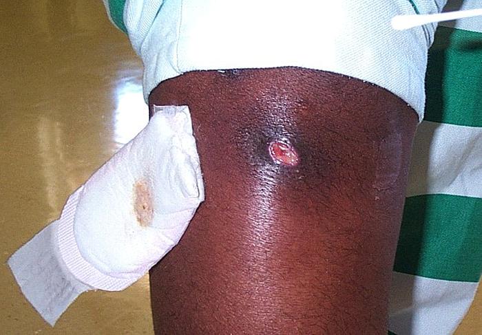 Knee Infection - Click for larger image