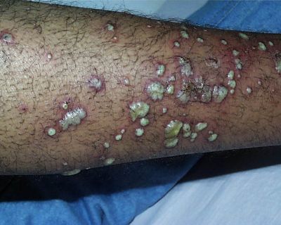 Leg Staph Infection